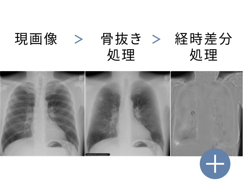 胸部Ｘ線骨組織透過／経時差分画像 ClearRead