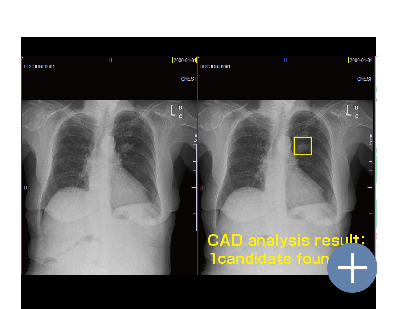 EIRL　Chest　Nodule