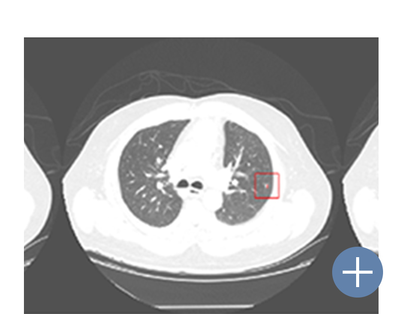 VUNO Med®-LungCT